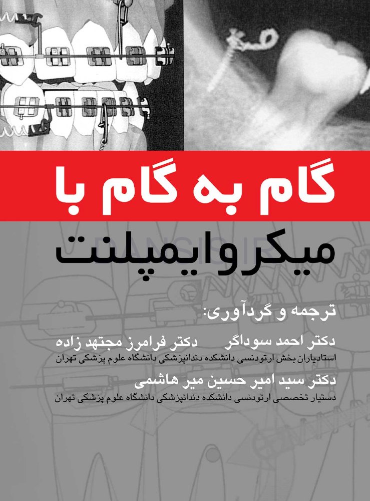 تصویر  گام به گام با میکروایمپلنت