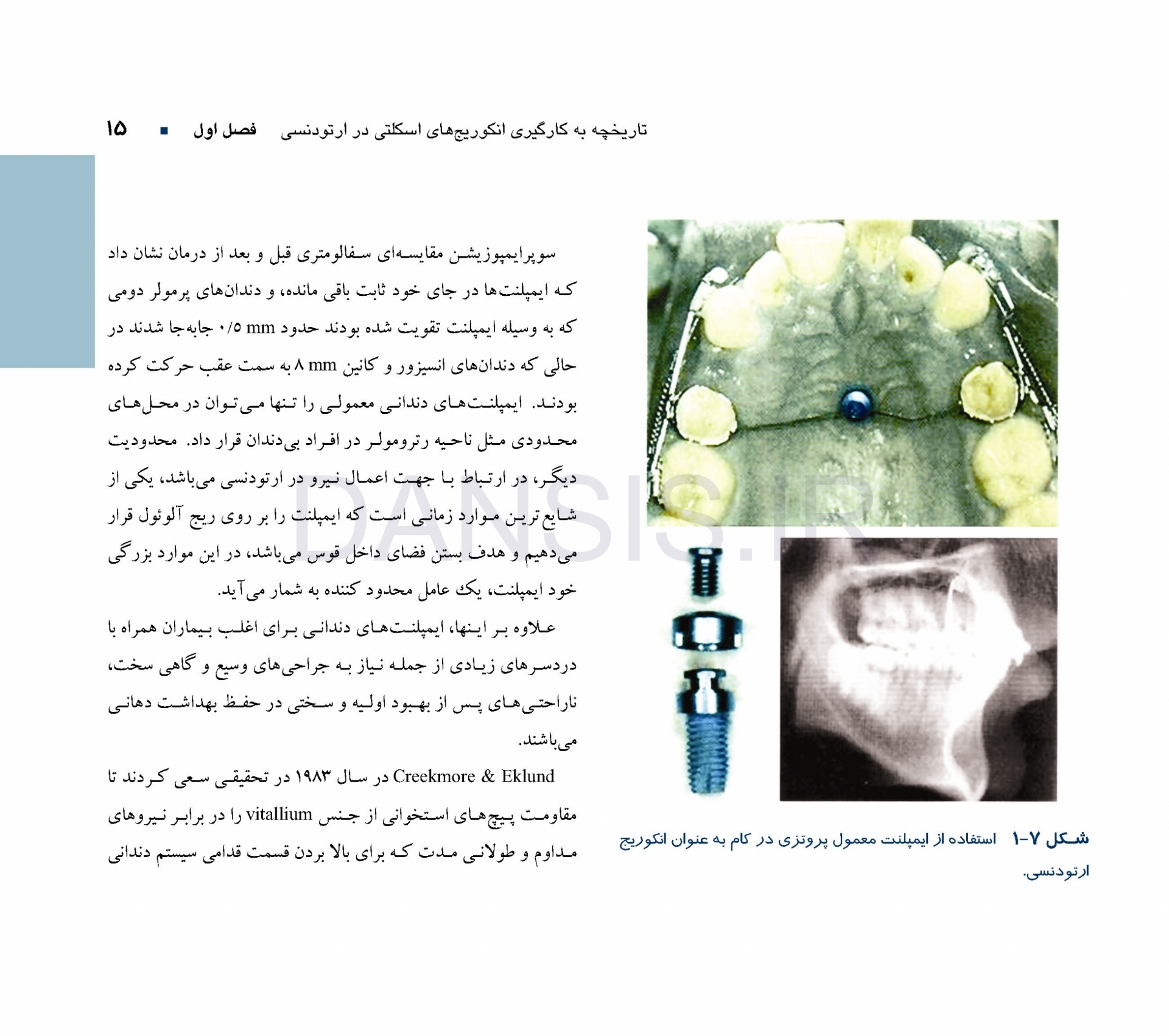تصویر  گام به گام با میکروایمپلنت