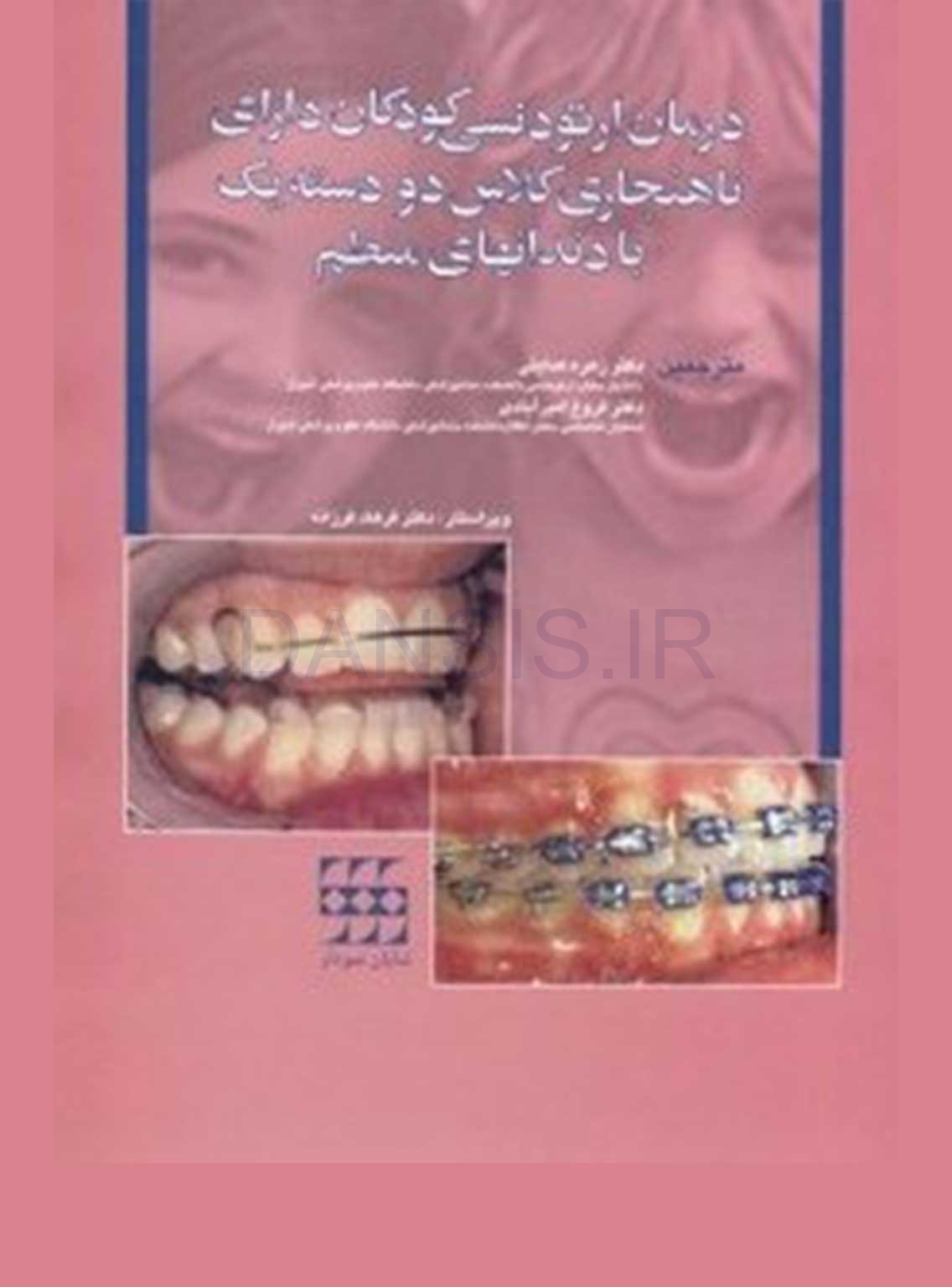 تصویر  درمان ارتودنسی کودکان دارای ناهنجاری کلاس دو دسته یک با دندان های منظم