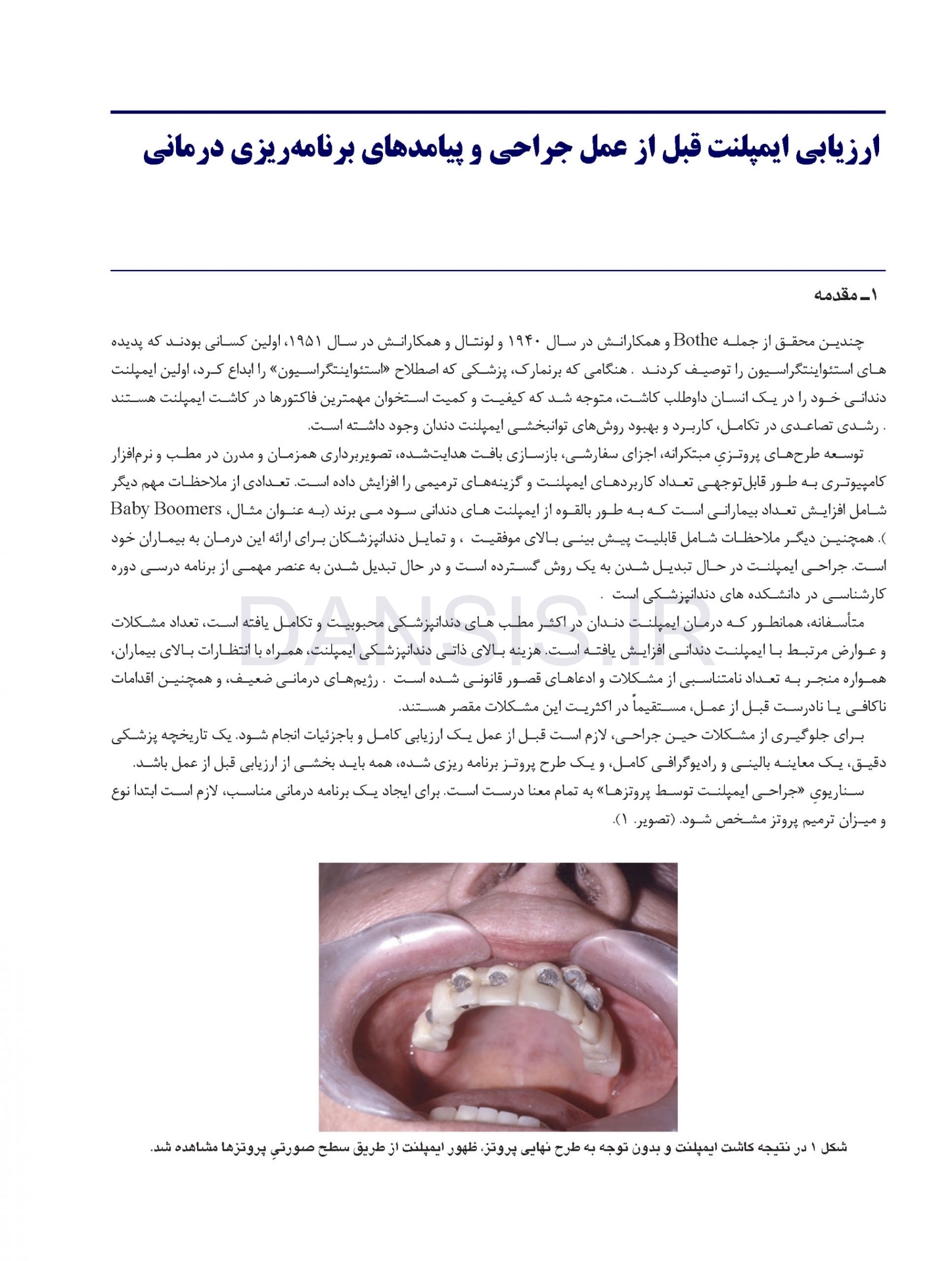 تصویر  عوارض پیچیده ی ایمپلنت های دندانی