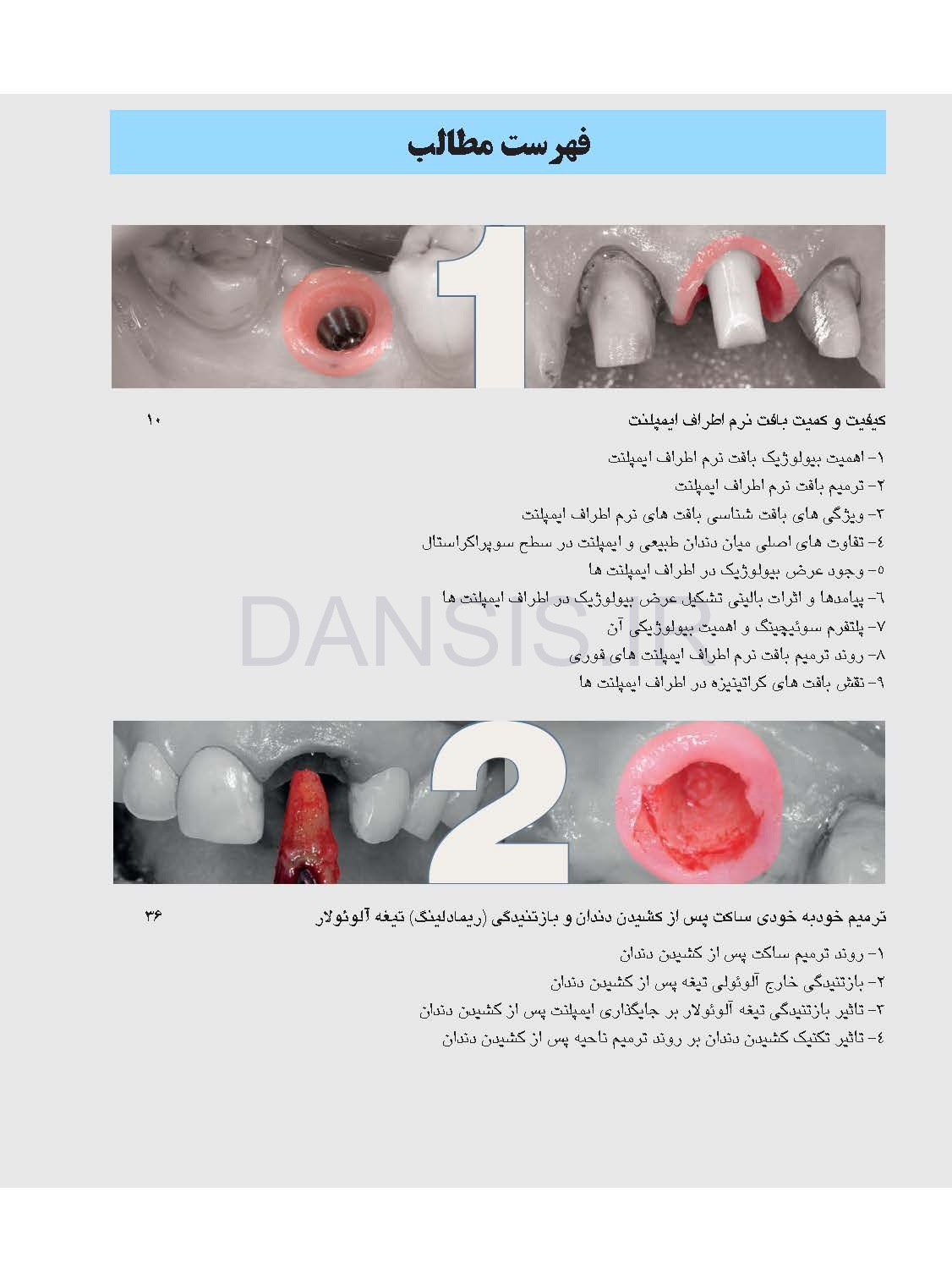 تصویر  زیبایی شناسی بافت نرم و پرسلن های صورتی رنگ در درمان با ایمپلنت