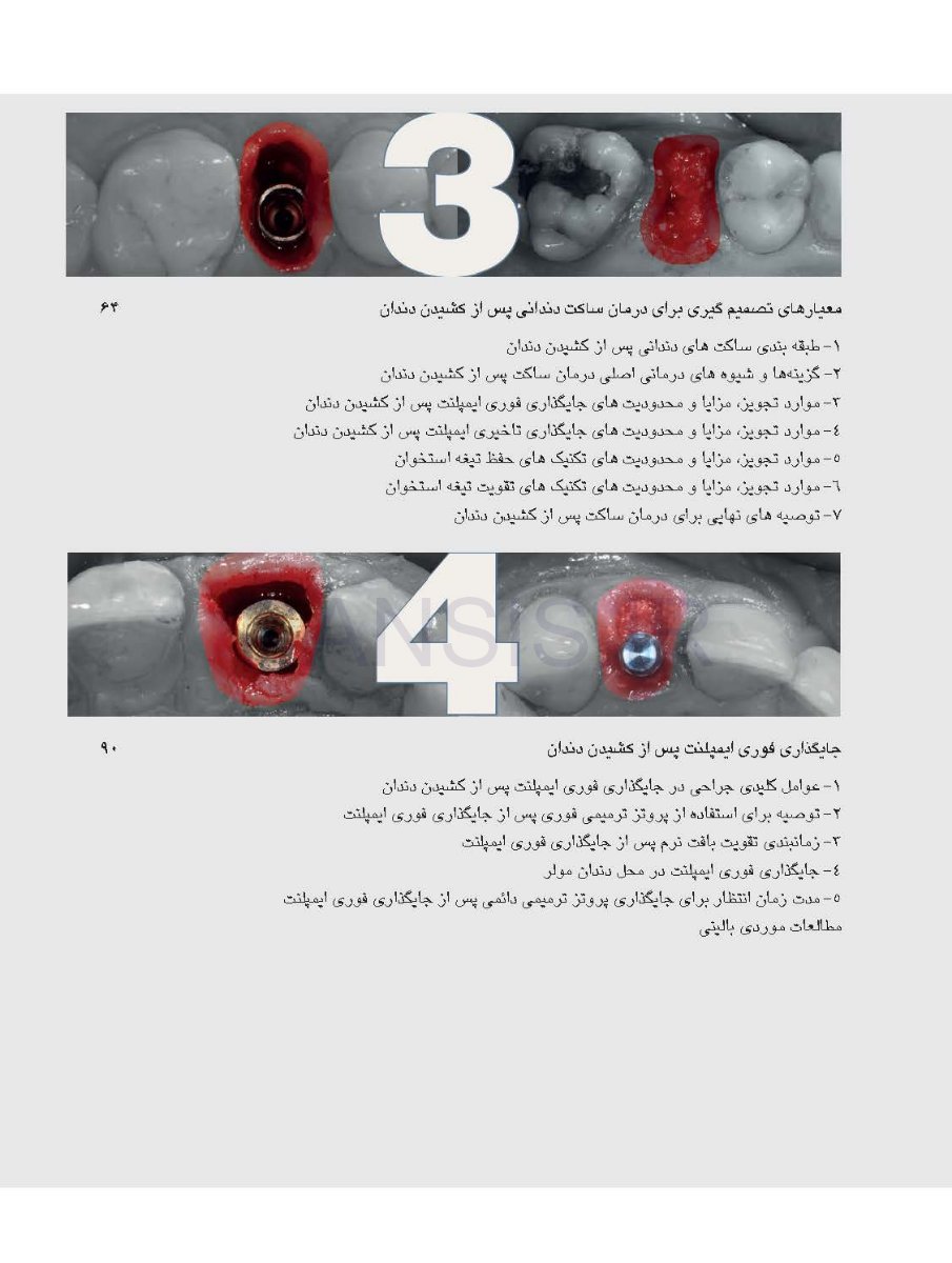 تصویر  زیبایی شناسی بافت نرم و پرسلن های صورتی رنگ در درمان با ایمپلنت