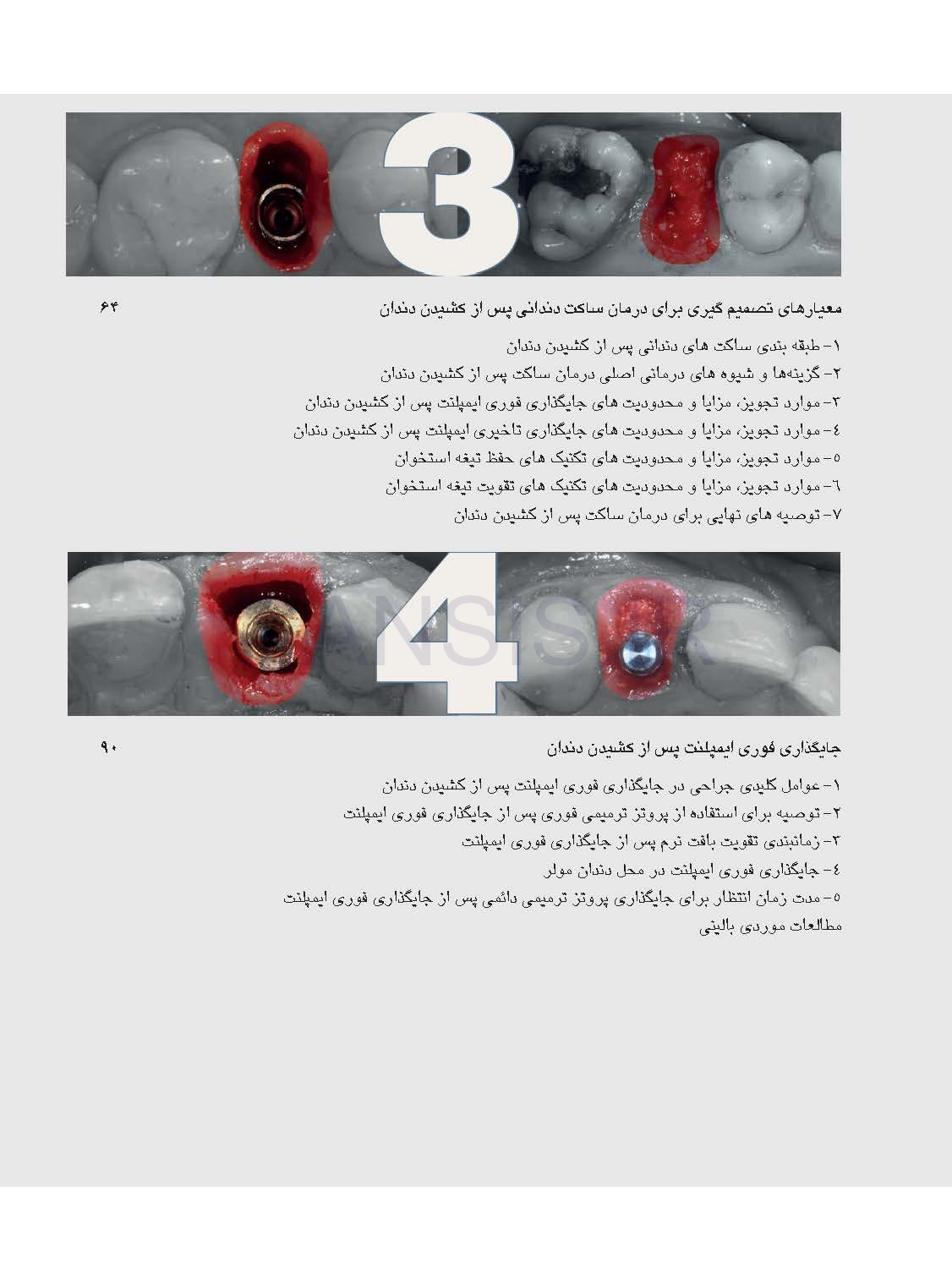 تصویر  زیبایی شناسی بافت نرم و پرسلن های صورتی رنگ در درمان با ایمپلنت