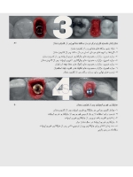 تصویر  زیبایی شناسی بافت نرم و پرسلن های صورتی رنگ در درمان با ایمپلنت