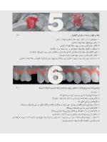 تصویر  زیبایی شناسی بافت نرم و پرسلن های صورتی رنگ در درمان با ایمپلنت