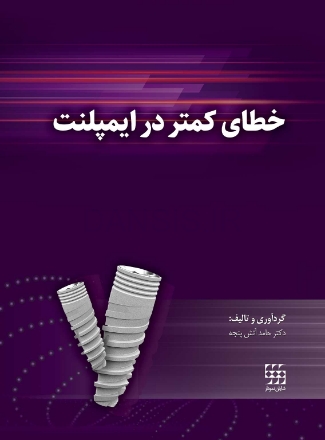 تصویر  خطای کمتر در ایمپلنت