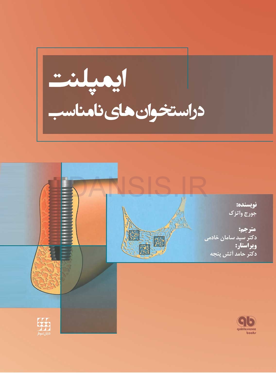 تصویر  ایمپلنت در استخوان های نامناسب