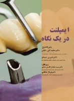 تصویر  ایمپلنت در یک نگاه