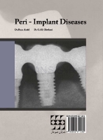 تصویر  بیماریهای اطراف ایمپلنت