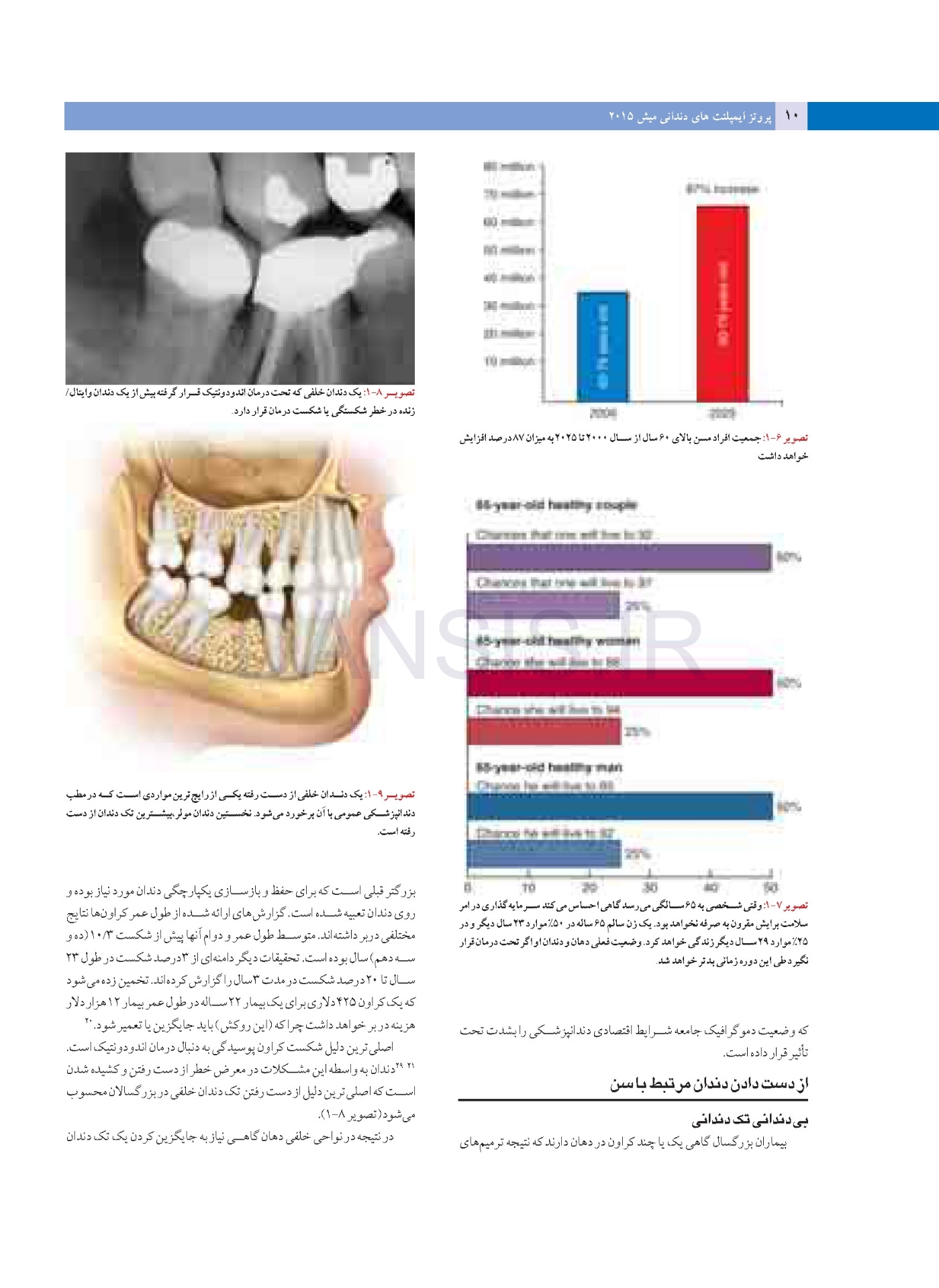 تصویر  پروتز ایمپلنت های دندانی میش 2015 ( گلاسه رنگی دوجلدی همراه با قاب)