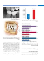 تصویر  پروتز ایمپلنت های دندانی میش 2015 ( گلاسه رنگی دوجلدی همراه با قاب)