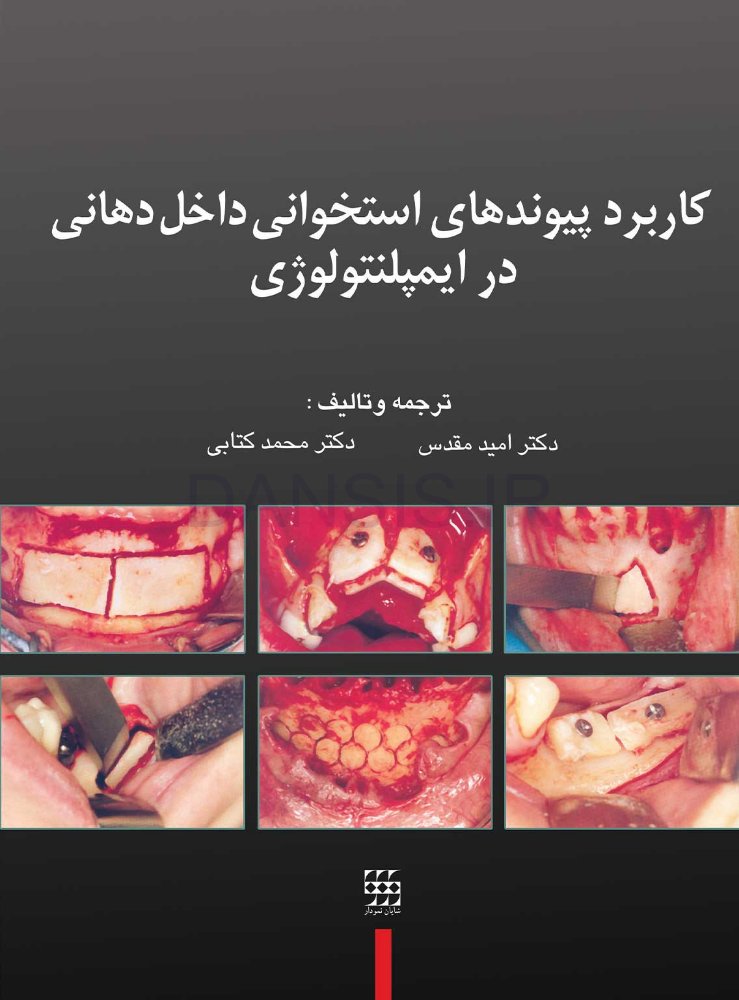 تصویر  کاربرد پیوندهای استخوانی داخل دهانی در ایمپلنتولوژی