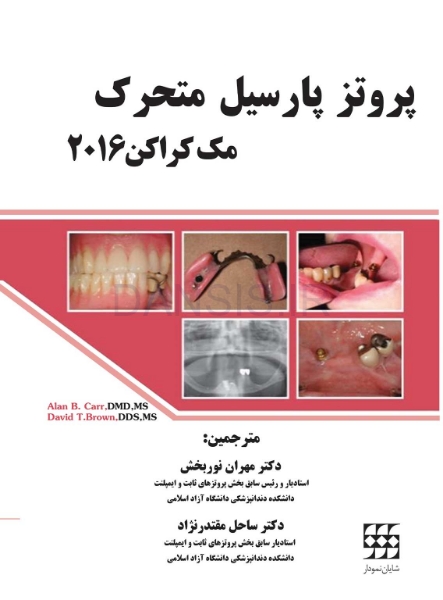 تصویر  پروتز پارسیل متحرک مک کراکن 2016