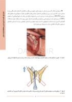 تصویر  اصول و روش های کشیدن محافظه کارانه دندان