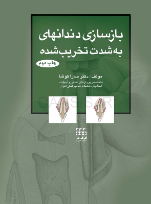 تصویر  بازسازی دندانهای به شدت تخریب شده (چاپ دوم)