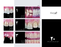 تصویر  پرسلن لمینیت ونیر(20 طرح درمان برای بازسازی لبخند)