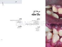 تصویر  پرسلن لمینیت ونیر(20 طرح درمان برای بازسازی لبخند)