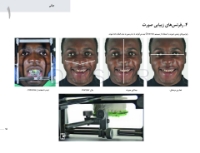 تصویر  پرسلن لمینیت ونیر(20 طرح درمان برای بازسازی لبخند)