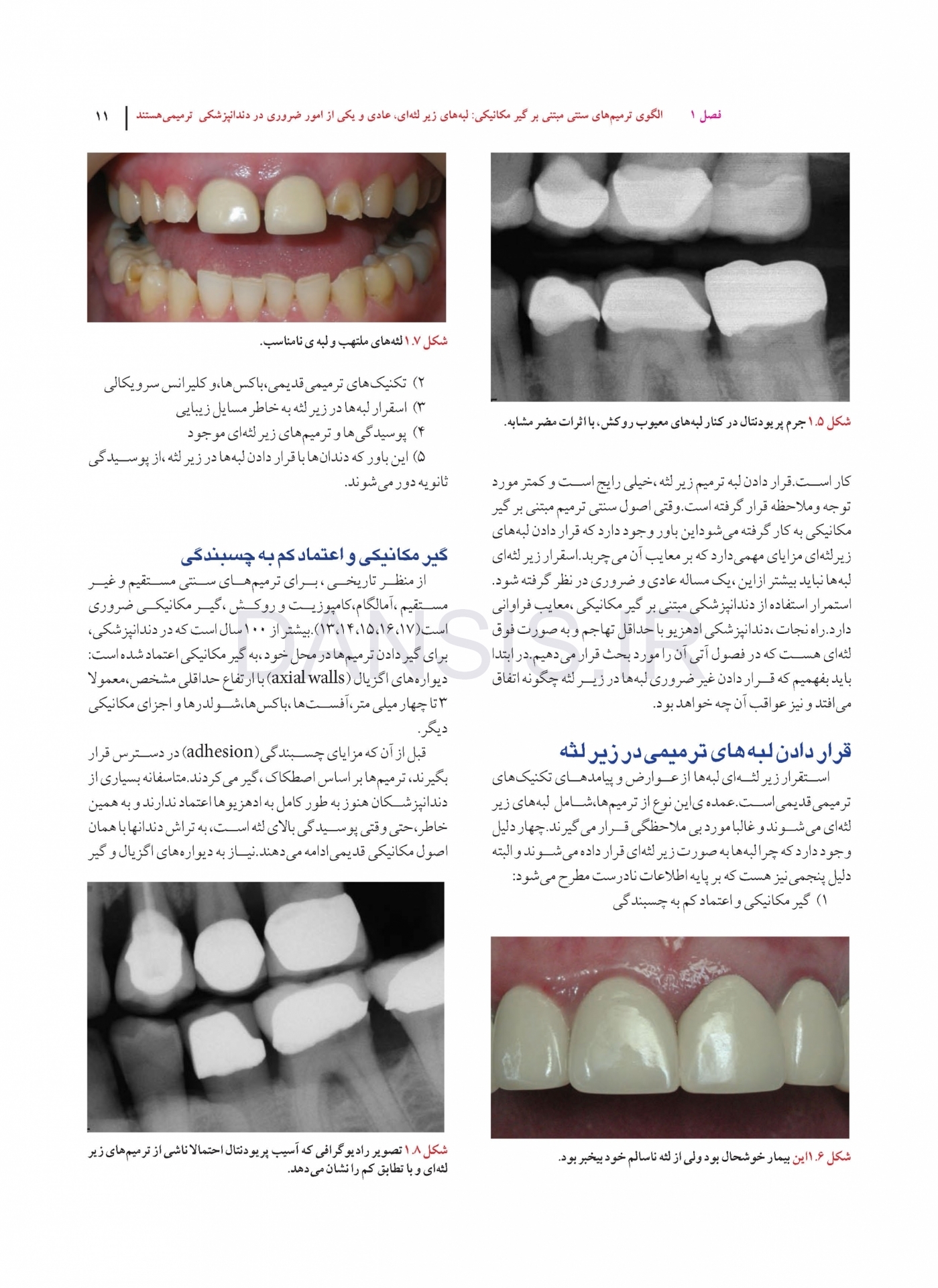 تصویر  دندانپزشکی کم تهاجمی فوق لثه ای (یک رویکرد سالم تر در ترمیم های زیبایی)