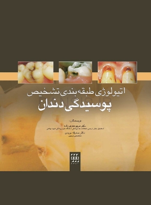 تصویر  اتیولوژی/طبقه بندی/تشخیص پوسیدگی دندان