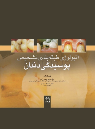 تصویر  اتیولوژی/طبقه بندی/تشخیص پوسیدگی دندان