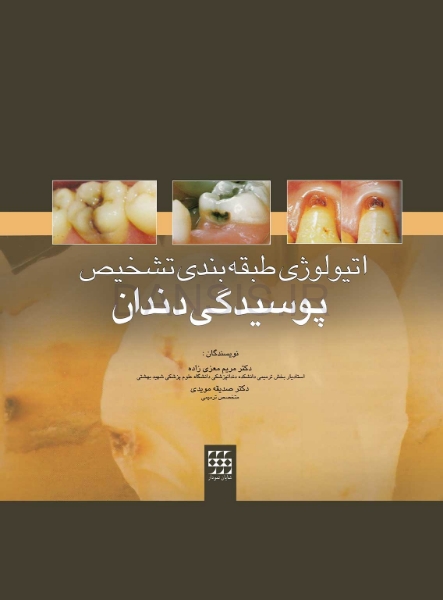 تصویر  اتیولوژی/طبقه بندی/تشخیص پوسیدگی دندان