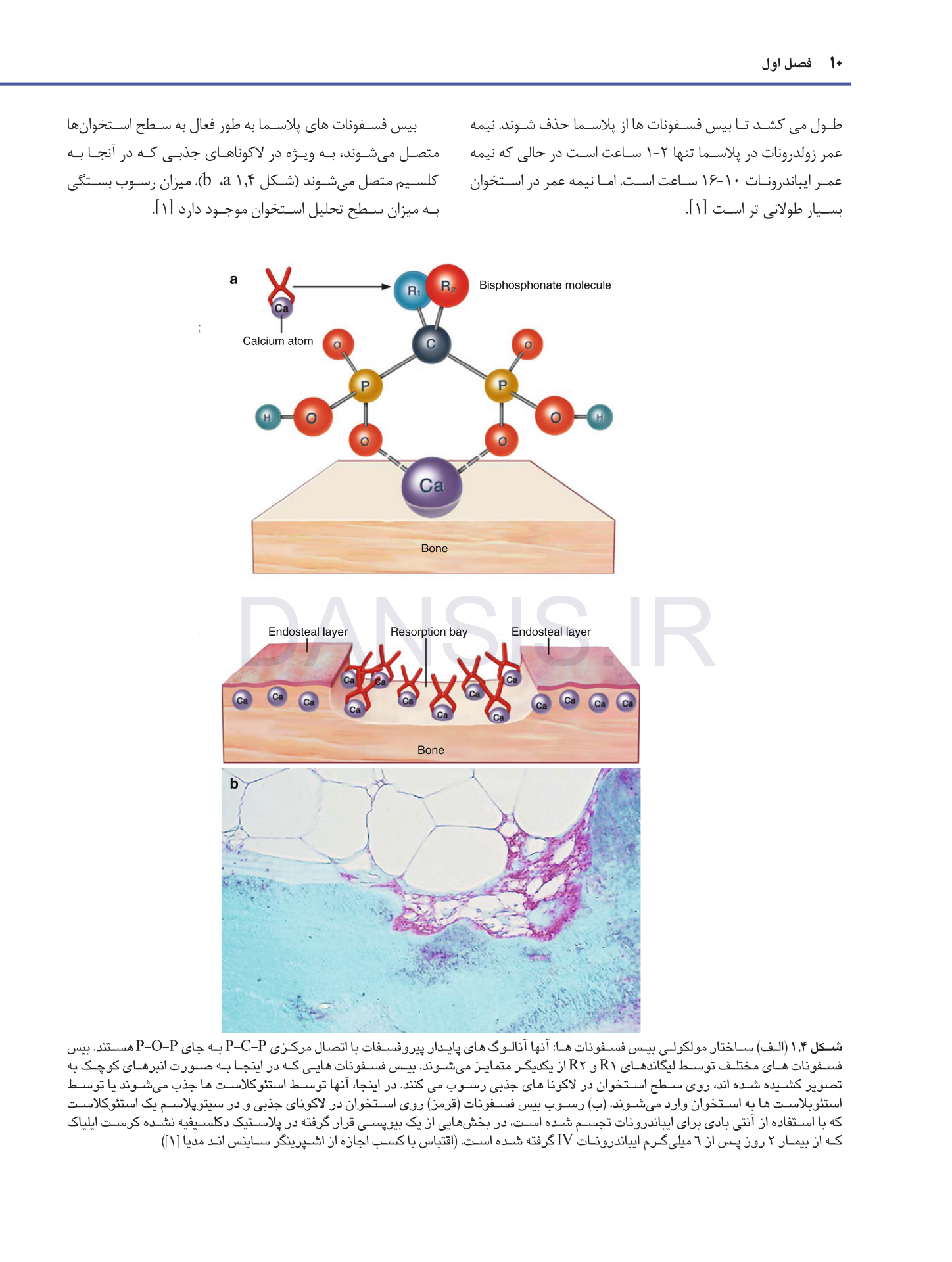 تصویر  استئونکروز فکین ناشی از مصرف داروها