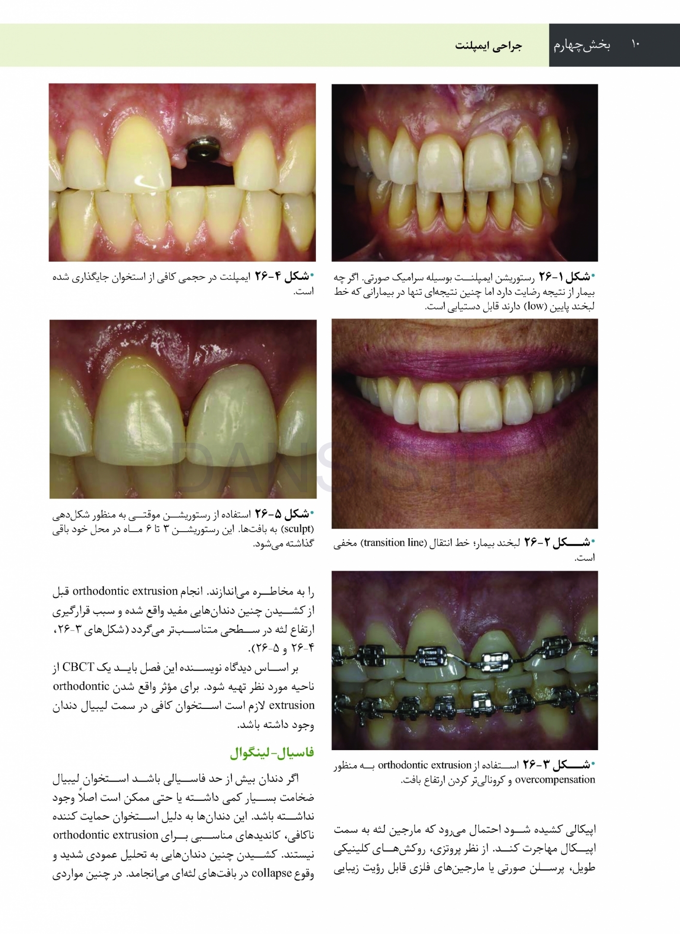تصویر  جراحی، دهان و فک و صورت فونسکا 2018 جلد پنجم (جراحی ایمپلنت)