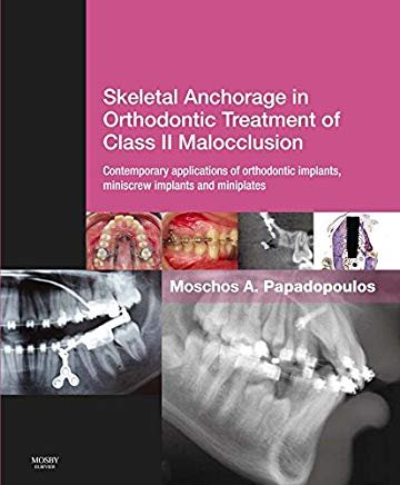 تصویر  Skeletal Anchorage in Orthodontic Treatment of Class II Malocclusion