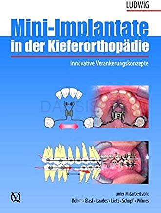 تصویر  Mini-Implant in Orthodontics
