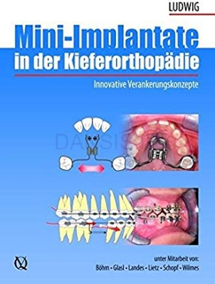 تصویر  Mini-Implant in Orthodontics