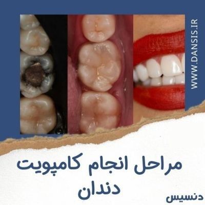 مراحل انجام کامپوزیت دندان