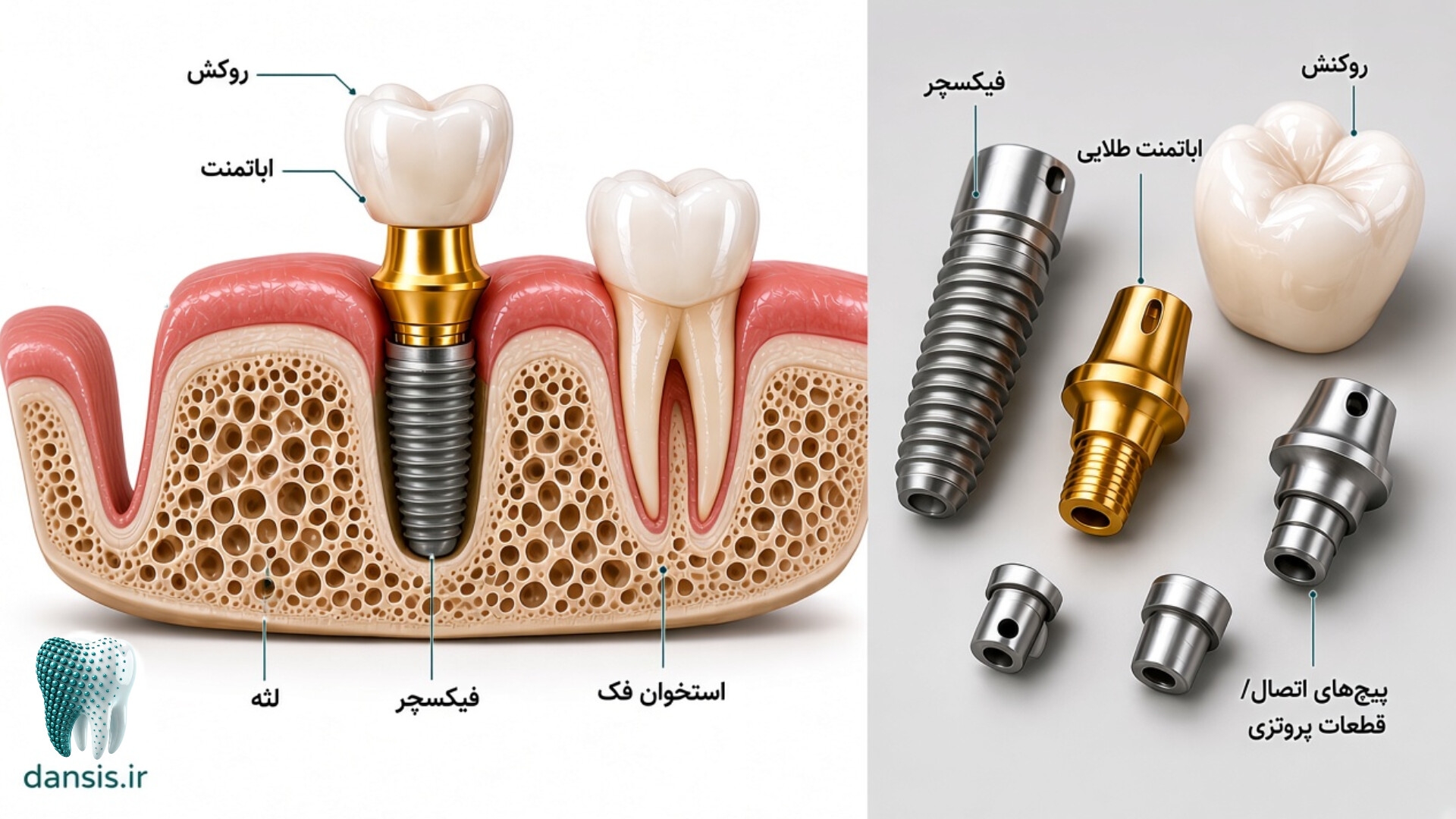 اجزای ایمپلنت دندانی چیست؟ راهنمای علمی فیکسچر، اباتمنت، پیچ و پروتز